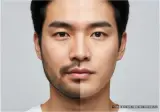 남양주시피부과 수염제모, 젠틀맥스프로 효과는?